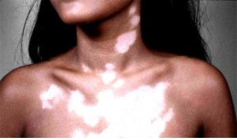 Vitiligo (11K)